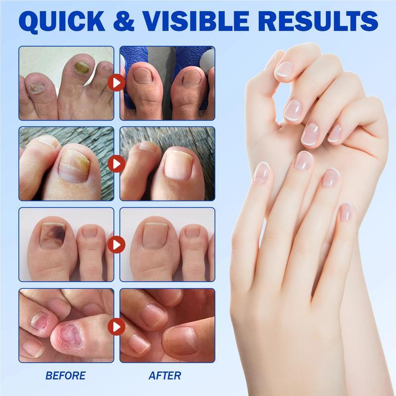 FUNGEX Fungal Nail Repair Patches