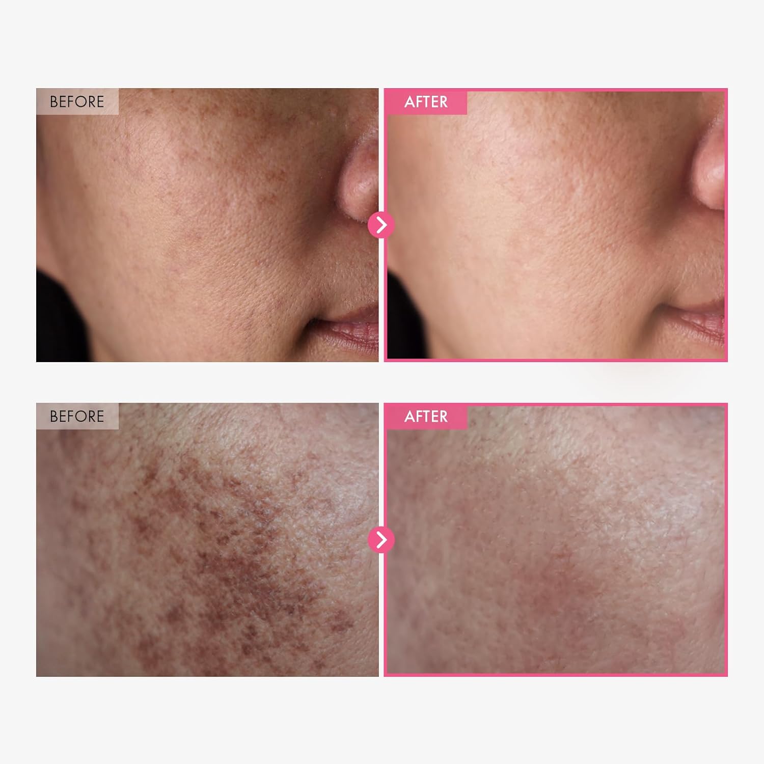 Fade Dark Spots Faster with Korean Arbutin